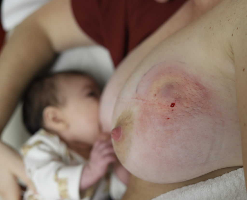 breastfeeding abscess